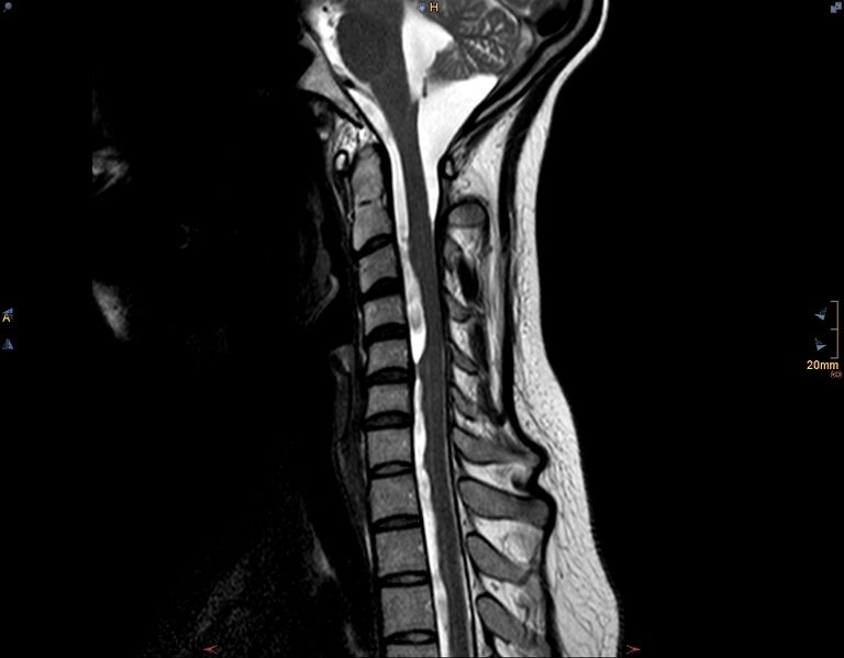 File:Arachnoid cyst - spinal (Radiopaedia 10055-10597 T2 1).jpg