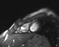 Arrhythmogenic right ventricular cardiomyopathy (Radiopaedia 69564-79464 short axis cine 32).jpg
