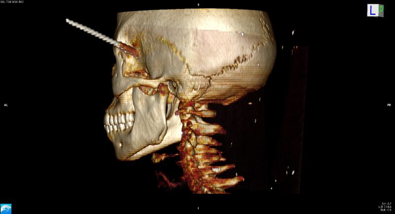File:Arrow injury to the head (Radiopaedia 75266-86388 3D horizontal 27).jpg