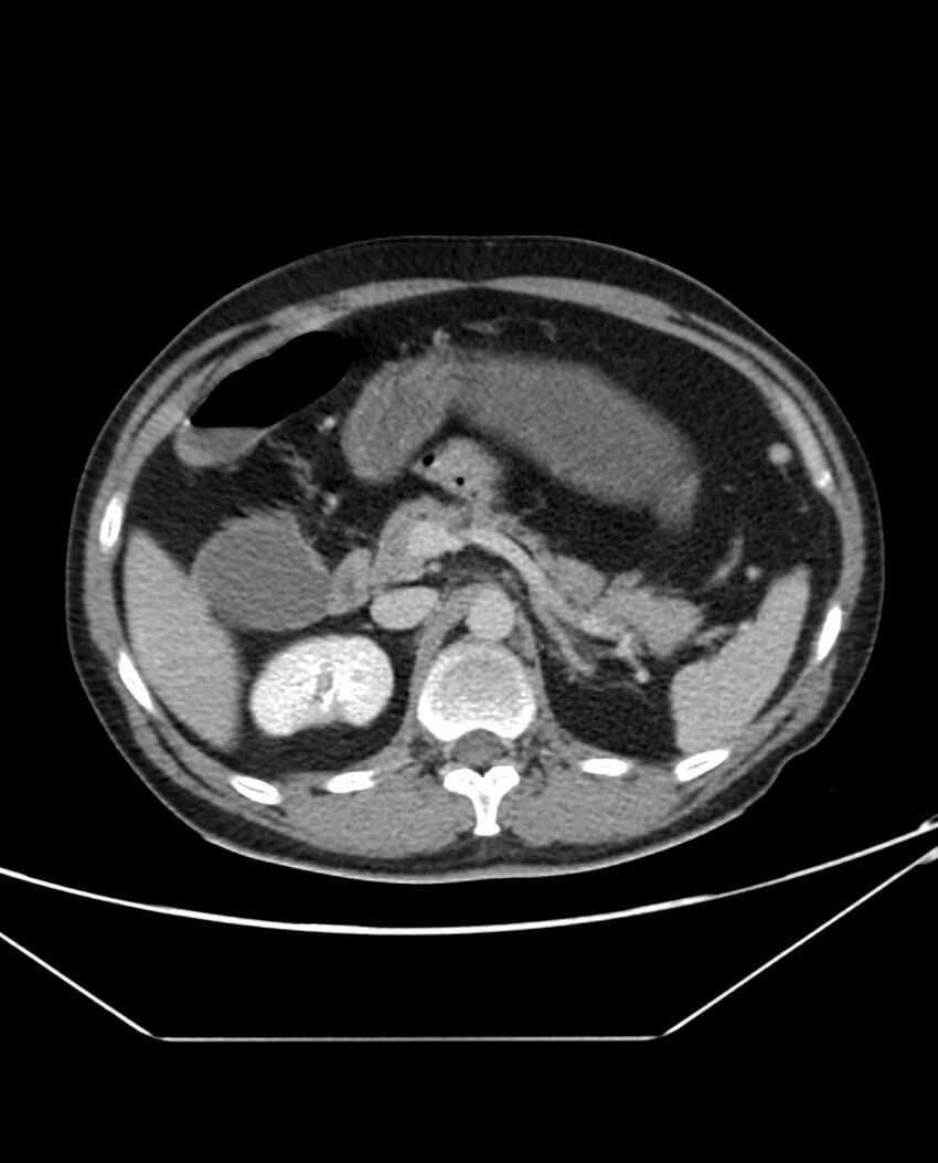 Arterial occlusive mesenteric ischemia (Radiopaedia 84641-100054 A 40).jpg