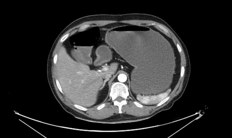 File:Arterial occlusive mesenteric ischemia (Radiopaedia 84641-100060 A 38).jpg