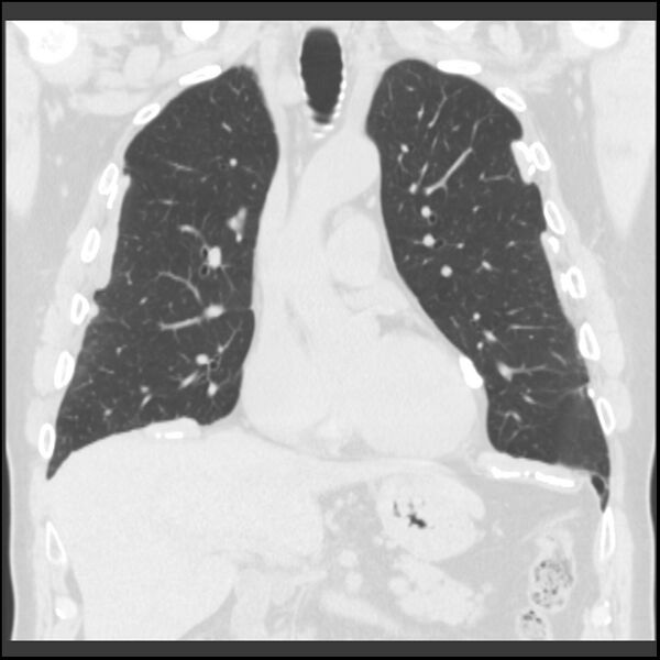 File:Asbestos-related pleural plaques (Radiopaedia 39069-41255 Coronal lung window 54).jpg