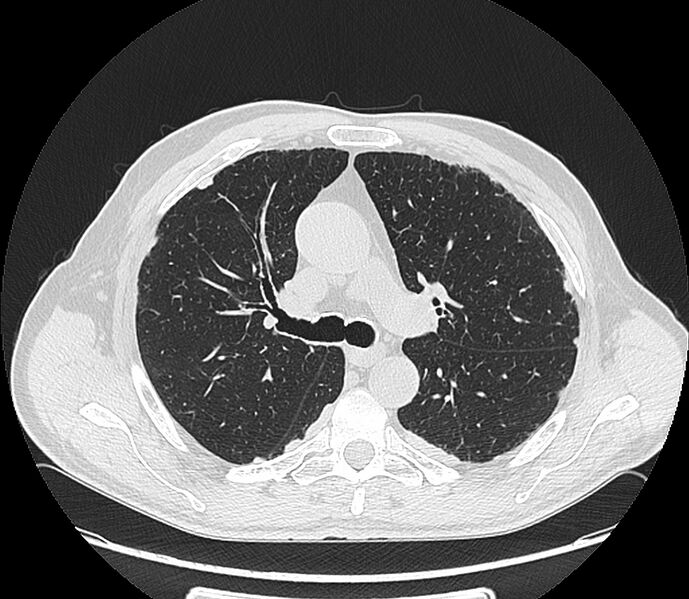 File:Asbestos pleural placques (Radiopaedia 57905-64872 Axial lung window 99).jpg