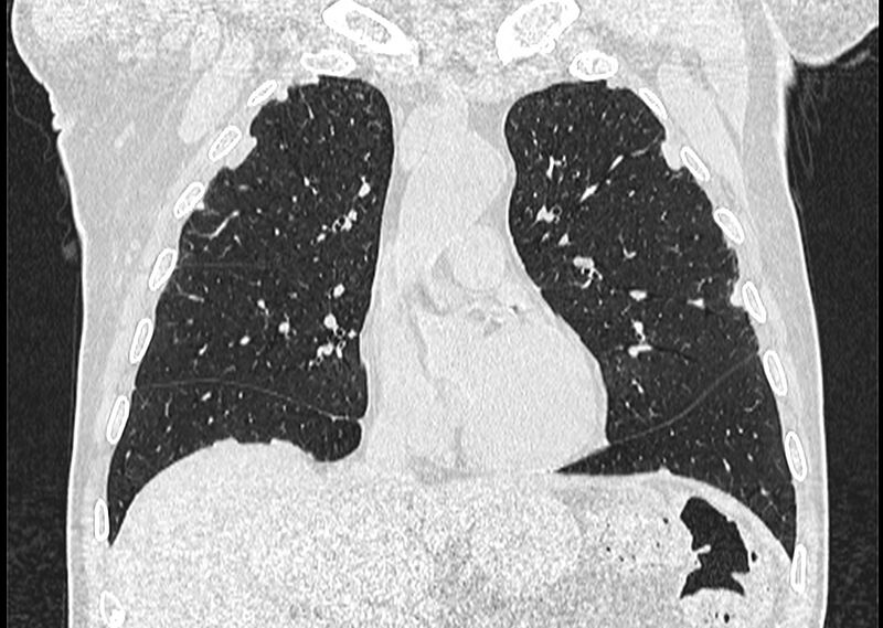 File:Asbestos pleural placques (Radiopaedia 57905-64872 Coronal lung window 111).jpg
