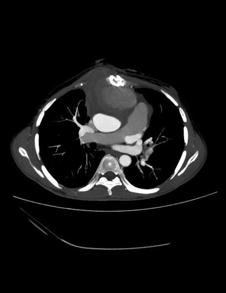 File:Ascending aortic pseudoaneurysm (Radiopaedia 28638-28910 A 12).jpg