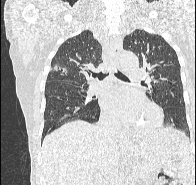 File:Aspergilloma (Radiopaedia 44592-48327 Coronal lung window 67).jpg