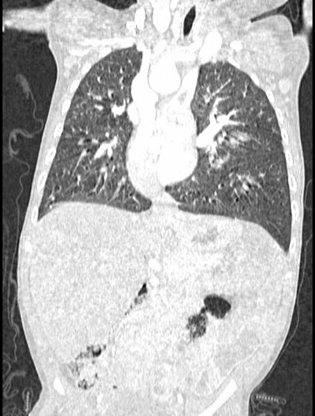 File:Asplenia syndrome (Radiopaedia 73083-83792 Coronal lung window 70).jpg
