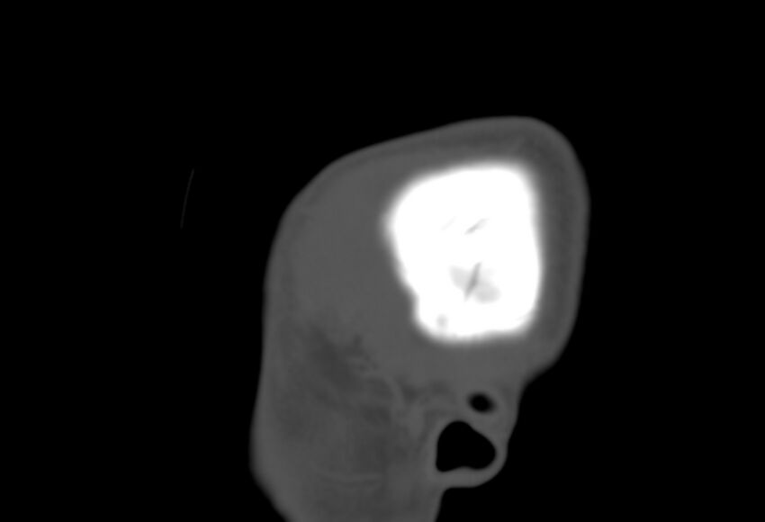Asymptomatic occipital spur (Radiopaedia 87753-104201 Sagittal bone window 1).jpg