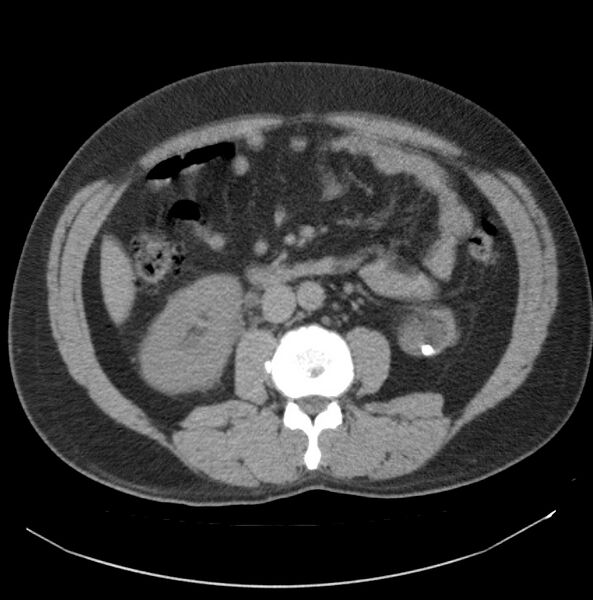 File:Atrophic kidney due to severe chronic obstructive hydronephrosis (Radiopaedia 40828-43474 Axial non-contrast 11).jpg