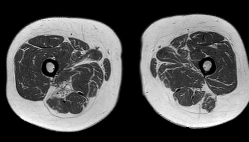 Atypical lipomatous tumor - thigh (Radiopaedia 68975-78734 Axial T1 62).jpg
