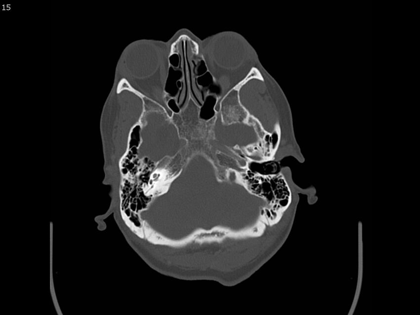 Atypical meningioma - intraosseous (Radiopaedia 64915-73867 Axial C+ bone window 15).jpg