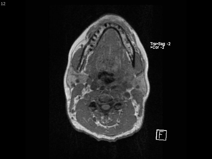 Atypical meningioma - intraosseous (Radiopaedia 64915-74572 Axial T1 12).jpg