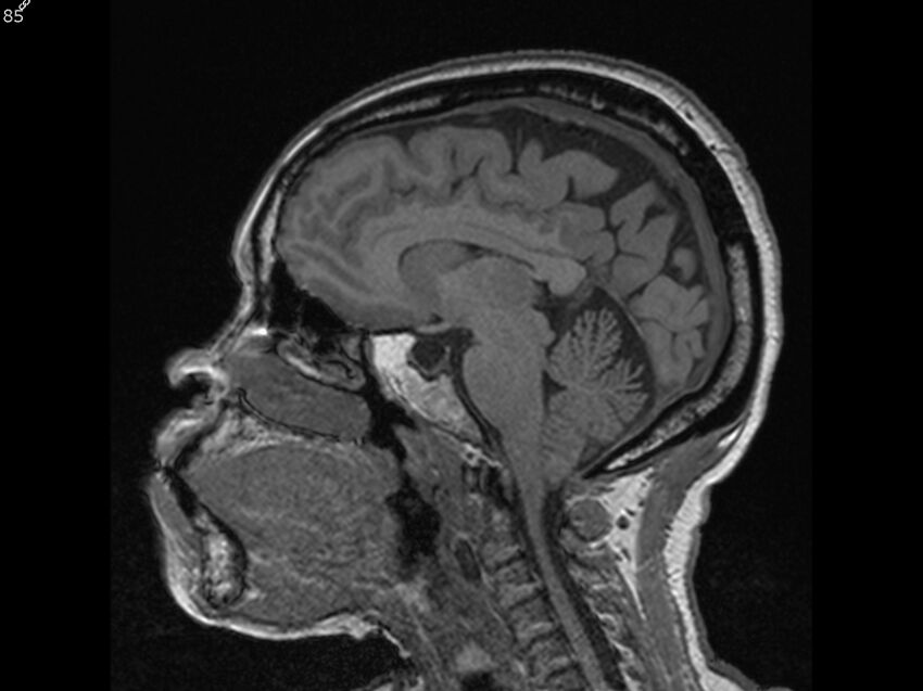 Atypical meningioma - intraosseous (Radiopaedia 64915-74572 Sagittal T1 85).jpg