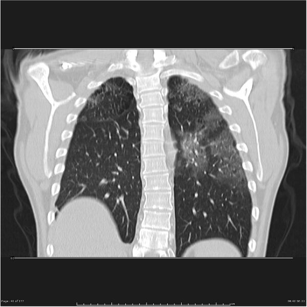 File:Atypical pneumonia - Q fever (Radiopaedia 21993-21989 C 34).jpg