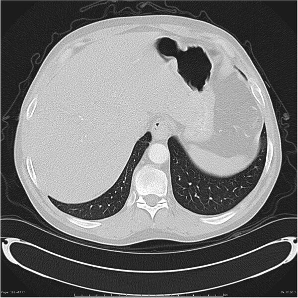 File:Atypical pneumonia - Q fever (Radiopaedia 21993-21989 lung window 45).jpg