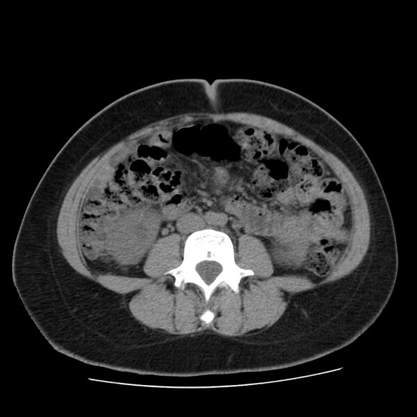 File:Autosomal dominant polycystic kidney disease (Radiopaedia 23061-23093 Axial non-contrast 38).jpg