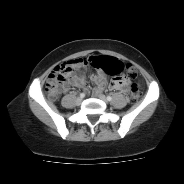 File:Autosomal dominant polycystic kidney disease (Radiopaedia 23061-23093 C 49).jpg