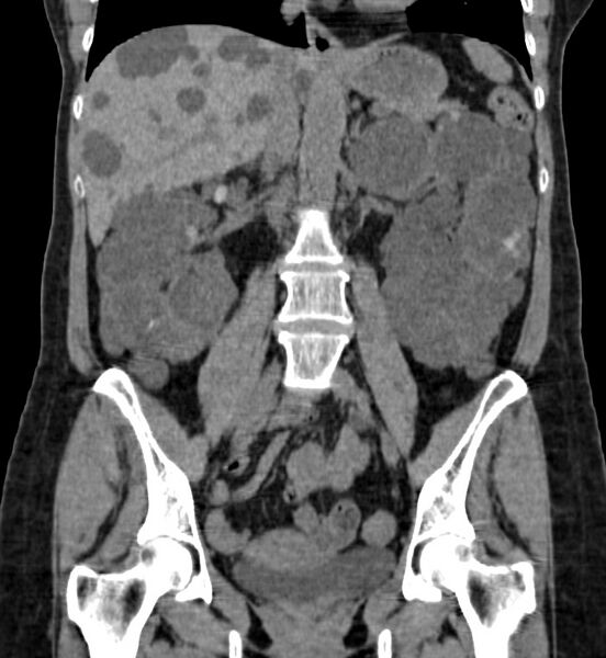 File:Autosomal dominant polycystic kidney disease (Radiopaedia 41918-44922 Coronal non-contrast 24).jpg