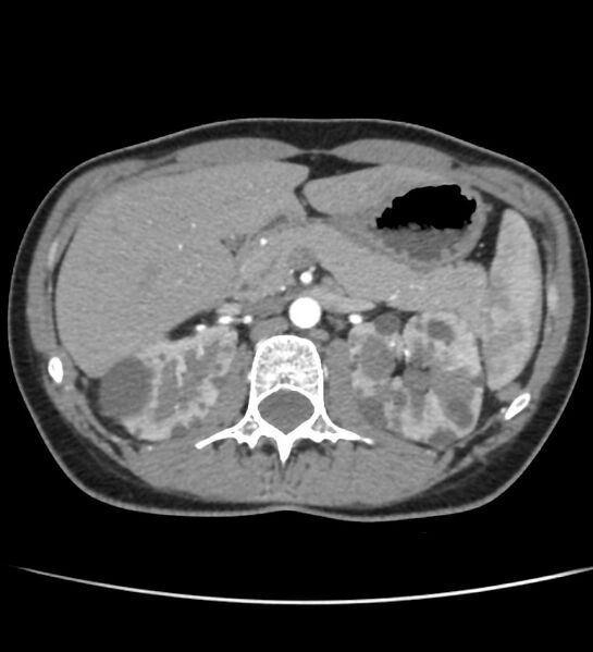 File:Autosomal dominant polycystic kidney disease - early onset (Radiopaedia 40734-43387 B 15).jpg