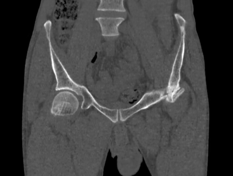 File:Avascular necrosis of the left hip (Radiopaedia 75068-86125 Coronal bone window 5).jpg
