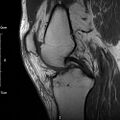 Avulsion fracture of the fibular head (Radiopaedia 74804-85808 D 16).jpg