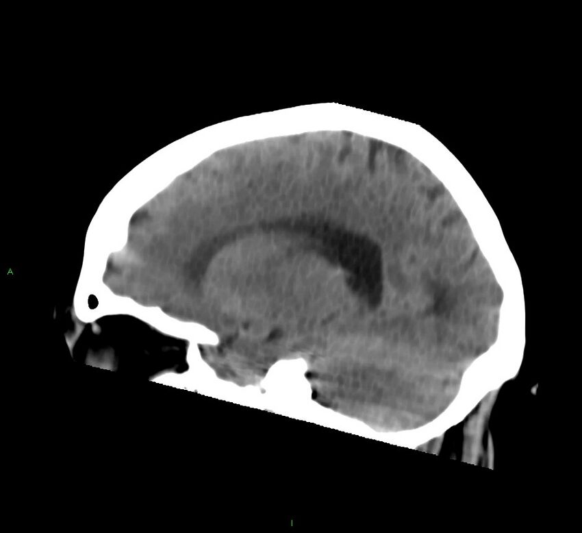 Basal ganglia hemorrhage (Radiopaedia 58759-65981 C 31).jpg