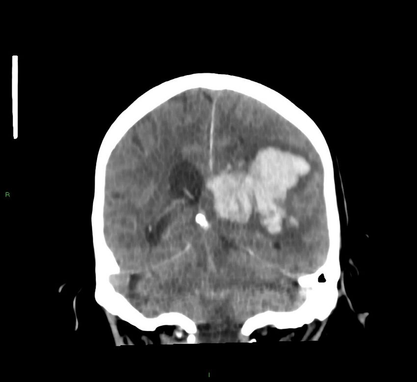 Basal ganglia hemorrhage (Radiopaedia 58767-65989 Coronal non-contrast 28).jpg