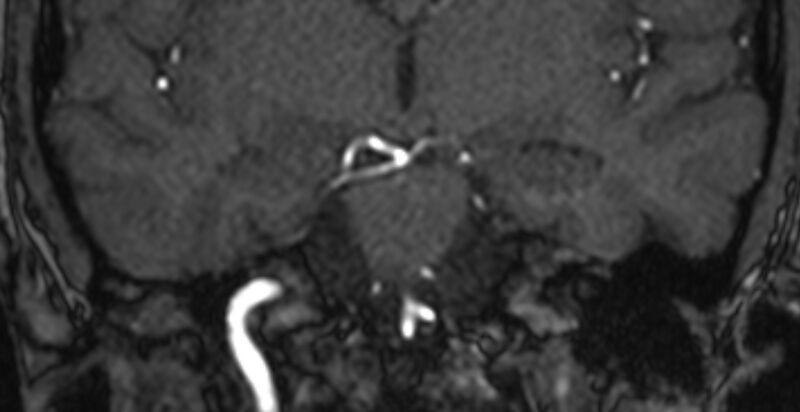 File:Basilar artery fenestration (Radiopaedia 74537-85455 Coronal MRA TOF 47).jpg