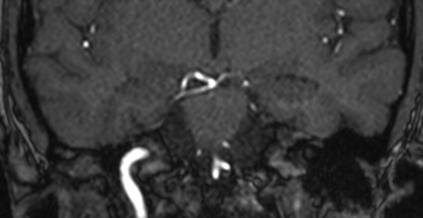 Basilar artery fenestration (Radiopaedia 74537-85455 Coronal MRA TOF 47).jpg