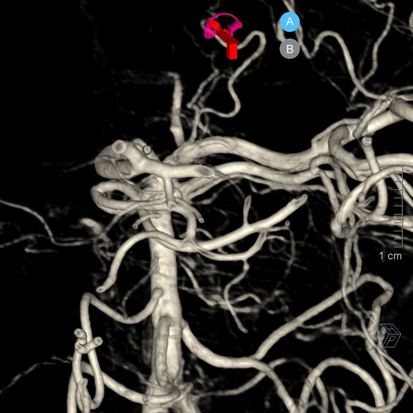 Basilar artery perforator aneurysm (Radiopaedia 82455-97734 3D view left VA 169).jpg