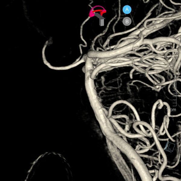 File:Basilar artery perforator aneurysm (Radiopaedia 82455-97734 3D view left VA 23).jpg