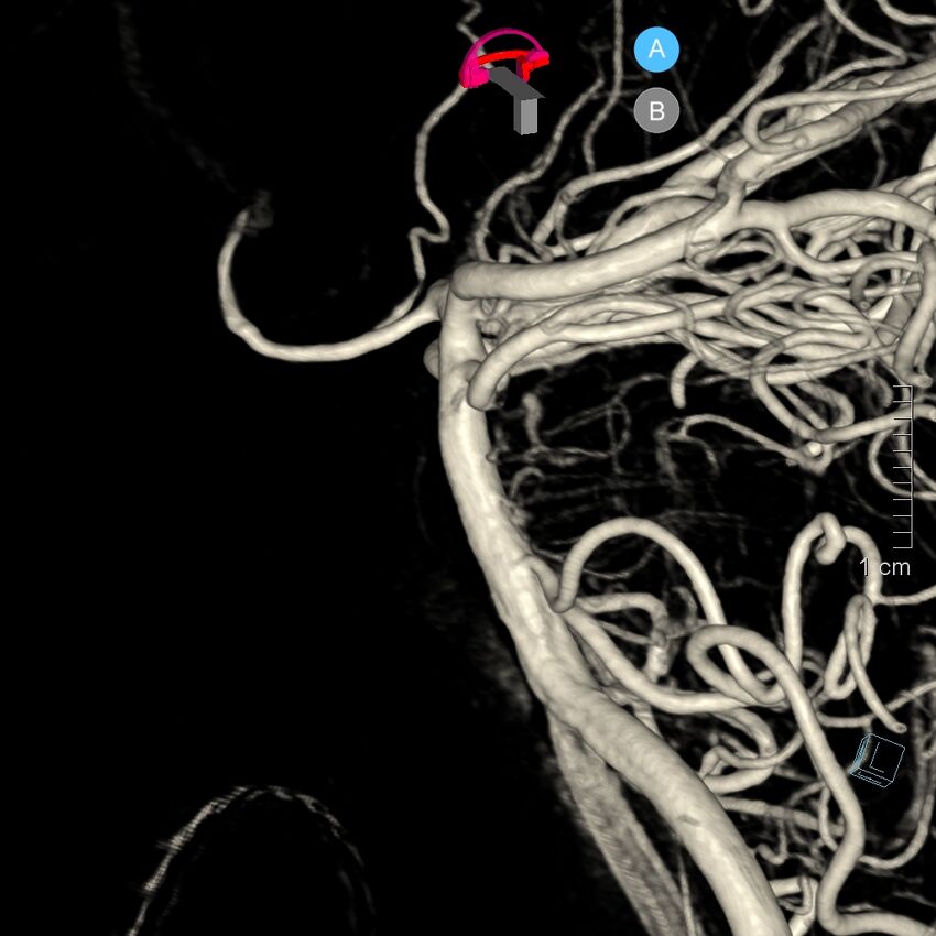 Basilar artery perforator aneurysm (Radiopaedia 82455-97734 3D view left VA 23).jpg