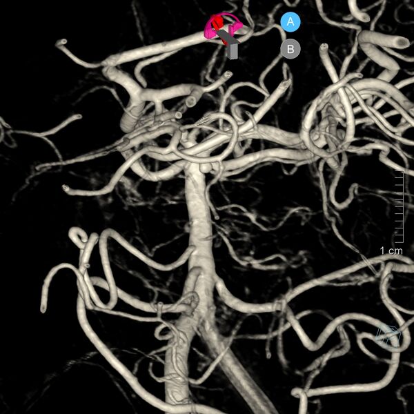 File:Basilar artery perforator aneurysm (Radiopaedia 82455-97734 3D view left VA 4).jpg