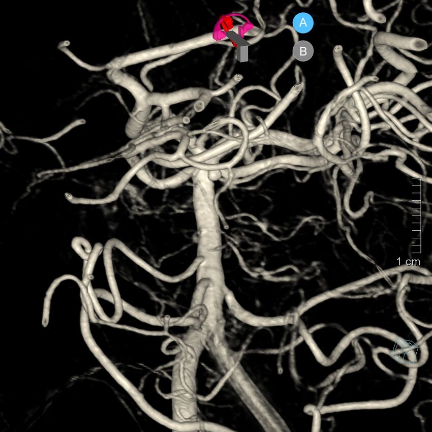 Basilar artery perforator aneurysm (Radiopaedia 82455-97734 3D view left VA 4).jpg