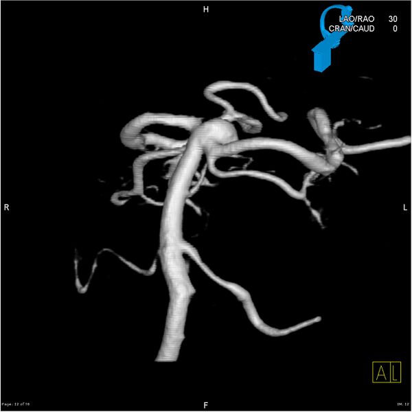 File:Basilar tip aneurysm double balloon remodeling (Radiopaedia 18100-17883 3D rotation 12).jpg