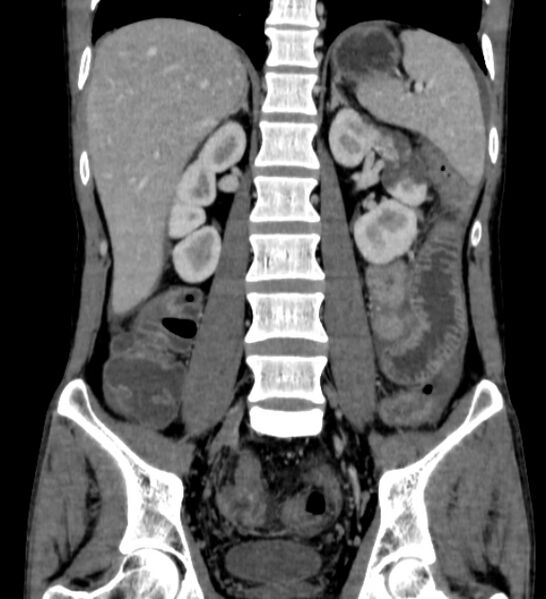 File:Behçet's disease- abdominal vasculitis (Radiopaedia 55955-62570 B 37).jpg