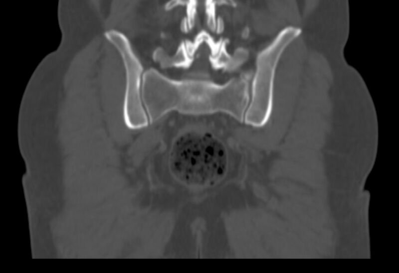 File:Bertolotti syndrome (Radiopaedia 58974-66235 Coronal bone window 11).jpg