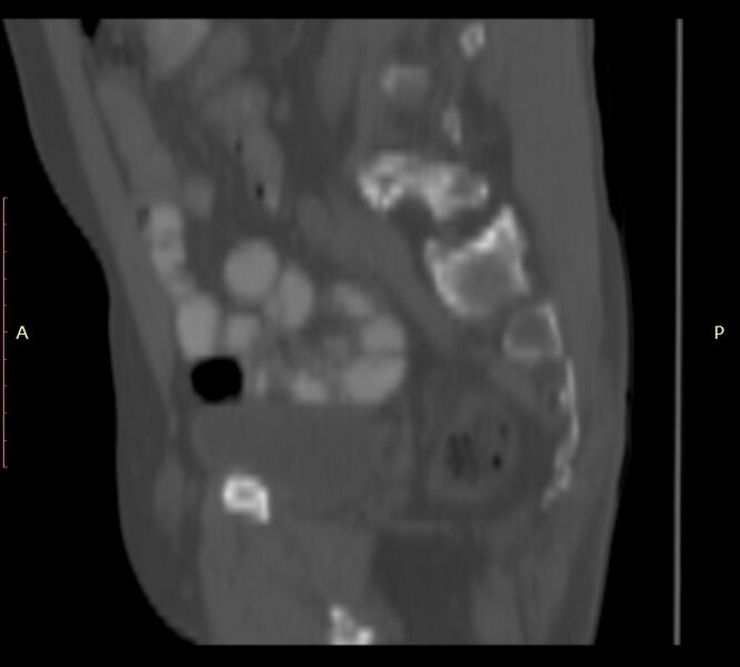 File:Bertolotti syndrome (Radiopaedia 58974-66235 Sagittal bone window 11).jpg