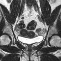 Bicornuate uterus (Radiopaedia 11104-11492 Coronal T2 9).jpg