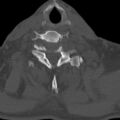 Bilateral C6-7 locked facet dislocation (Radiopaedia 28506-28748 Axial bone window 26).jpeg