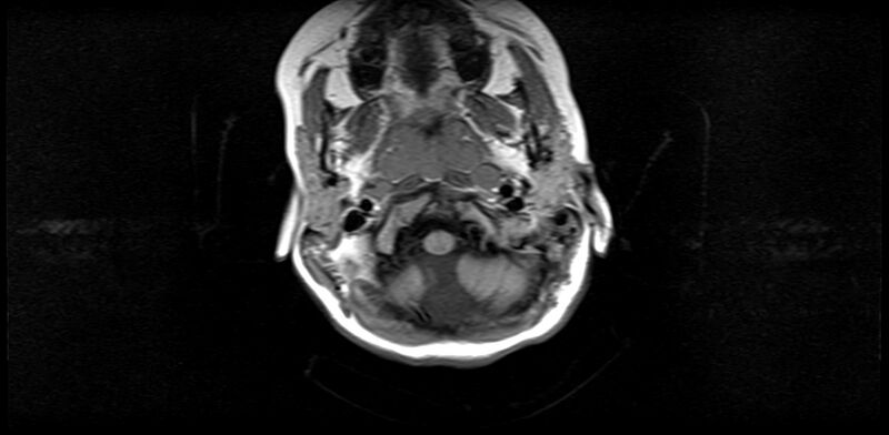 File:Bilateral Sprengel deformity with Klippel-Feil syndrome (Radiopaedia 66395-75650 Axial T1 4).jpg