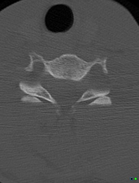 File:Bilateral cervical locked facets (Radiopaedia 21424-21364 Axial bone window 1).jpg
