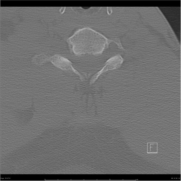 File:Bilateral cervical ribs (Radiopaedia 25868-26017 Axial bone window 39).jpg