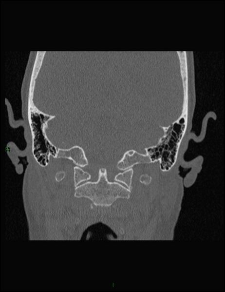 File:Bilateral frontal mucoceles (Radiopaedia 82352-96454 Coronal 349).jpg