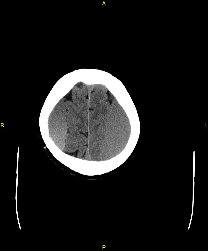 Bilateral isodense subdural hematomas (Radiopaedia 88621-105325 Axial non-contrast 93).jpg
