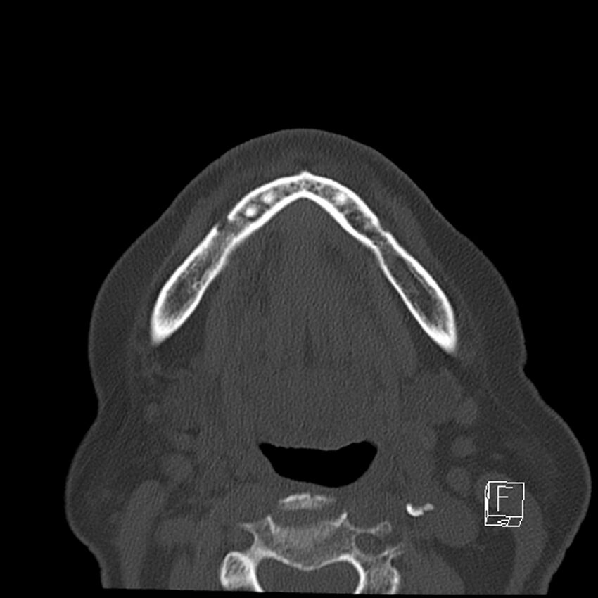 Bilateral palatine tonsilloliths on OPG and CT (Radiopaedia 75167-86247 Axial bone window 51).jpg