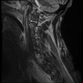 Bilateral perched facets with cord injury (Radiopaedia 45587-49714 Sagittal STIR 13).jpg
