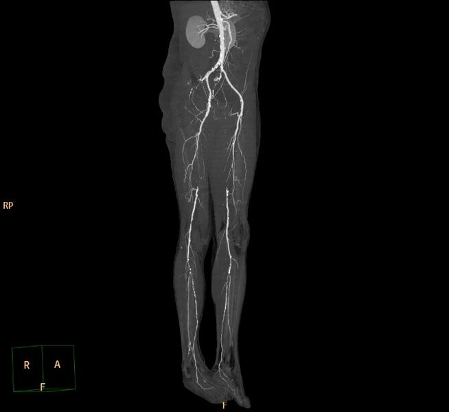 File:Bilateral superficial femoral arterial occlusion (Radiopaedia 25682-25857 3D MIP 4).jpg