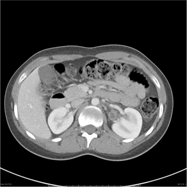 File:Bilateral ureteritis and cystitis (Radiopaedia 25340-25594 A 25).jpg
