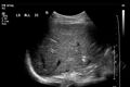 Biliary necrosis - liver transplant (Radiopaedia 21876-21843 A 3).jpg